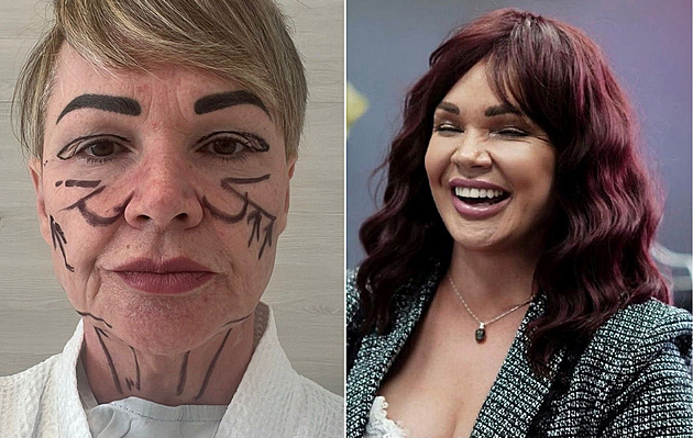 Po faceliftu čekala žena dokonalost, dočkala se jizev a znetvoření