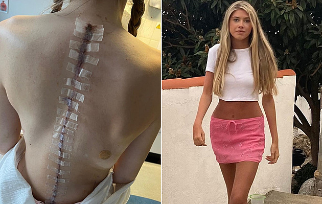 Dívka má za sebou mrtvici, operace páteře i srdce. Život ale nevzdává